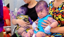 Mẹ không chích ngừa trước sinh, hàng loạt trẻ dưới 3 tháng tuổi mắc bệnh thủy đậu nhập viện tại TP.HCM