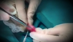 Tiểu phẫu sùi mào gà hết 70 triệu, phòng khám có bác sĩ Trung Quốc ở Đà Nẵng bị tố 'chặt chém'