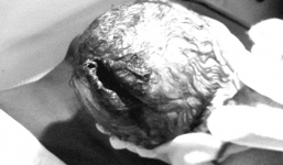 Bà nội dùng dao đỡ đẻ khiến bé sơ sinh bị rách vệt dài trên đầu