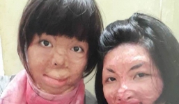 2 người phụ nữ bị chồng tẩm xăng đốt “nắm tay” nhau tô hồng cuộc sống