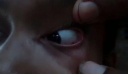 Bác sĩ sốc nặng khi phát hiện cả ổ kiến trong mắt bé gái