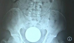 Người đàn ông nhập viện vì đau quặn bụng, bác sĩ kinh ngạc khi nhận ra thứ này trong hậu môn