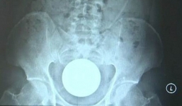 Người đàn ông nhập viện vì đau quặn bụng, bác sĩ phát hoảng khi nhận ra thứ này trong hậu môn