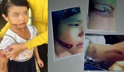 Mới nhất vụ bé gái nghi bị cha ruột, mẹ kế bạo hành: Chờ chỉ đạo từ Bộ Công an