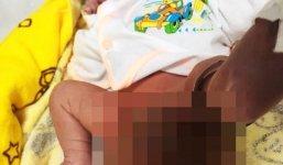 TP HCM: Bé gái sơ sinh mang khối u quái dị hình dạng như bào thai