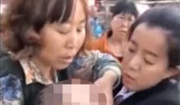 Bị táo rơi trúng đầu, bé 3 tháng tuổi nứt sọ