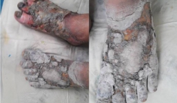 Nhiều bệnh nhân phải cắt bỏ bàn chân vì ngân châm lá cây lạ không rõ nguồn gốc