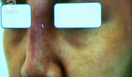 Cô gái 28 tuổi suýt hỏng mũi, biến dạng mặt nặng nề sau khi tiêm chất làm đầy trôi nổi