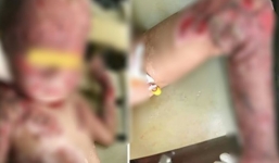 Xúc động ông bố hiến da cứu con trai 3 tuổi bỏng toàn bộ cơ thể vì cháy nhà