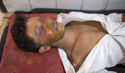 Nam thanh niên bị bạn gái 16 tuổi tạt axit đến biến dạng khuôn mặt vì từ chối lời tỏ tình