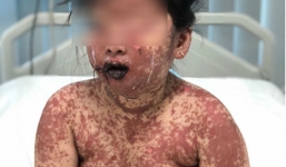 Bé 7 tuổi bị bỏng nặng toàn thân vì dùng thuốc bừa bãi