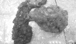 Lén chồng đi tiêm “mỡ nhân tạo” lên ngực, cô vợ 37 tuổi ở TP.HCM nhận cái kết nặng nề