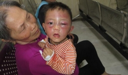 Bé trai 2 tuổi thâm tím mặt mày, nghi vấn do bố dượng bạo hành dã man