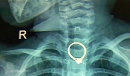 Mẹ giật mình phát hiện chiếc nhẫn kim cương biến mất hóa ra nằm trong bụng con gái 2 tuổi