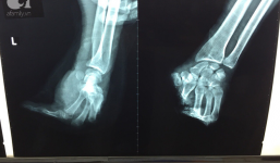 Tai nạn kinh hoàng: Người đàn ông ở Bình Dương bị máy cưa cắt đứt lìa tay