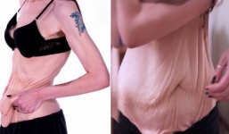 Hậu giảm cân, cô gái bị trầm cảm nặng vì làn da chảy xệ