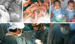 Cậu bé may mắn sống sót trong cặp song sinh dính nhau Nghĩa - Đàn giờ ra sao?