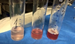 Nhiều lần ho ra máu, bé gái 13 tuổi phát hiện mắc chứng bệnh cực kỳ hiếm gặp trên thế giới