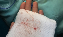 Thiếu nữ Bạc Liêu bị hủy hoại dung nhan vì đi nâng mũi bằng chỉ