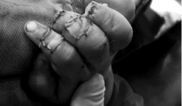 Đưa tay vào khe cửa sắt, bé trai hai tuổi ở Đồng Nai bị kẹp đứt đầu ngón tay