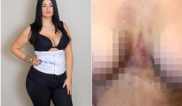 Chi gần 100 triệu đồng để 'nâng cấp' vòng 3 cho giống thần tượng, người phụ nữ suýt chết trên bàn mổ mà không hay biết