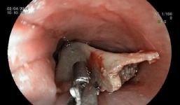 Bé gái 13 tuổi ở Bình Dương vừa xem tivi vừa ăn, suýt chết vì nuốt xương