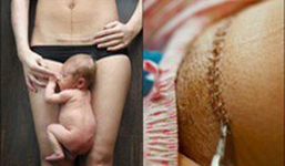 Xem những hình ảnh sinh mổ để thấy các bà mẹ đã trải qua đau đớn như thế nào