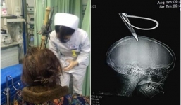 Người phụ nữ thoát chết trong gang tấc sau khi bị kéo rơi trúng đầu