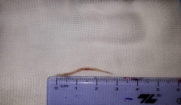 Cụ ông bị xương cá đâm thủng dạ dày