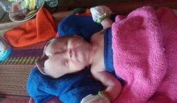 Xót xa cảnh em bé chào đời với đầu biến dạng vì không có hộp sọ