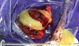 Trẻ 2 tuổi viêm phổi nhiều lần, đi khám phát hiện dị tật hiếm gặp