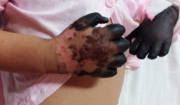 Xót thương bé gái bị hoại tử tứ chi do nhiễm bệnh than hiếm gặp