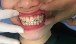 Cô gái hi sinh gắn đá nguyên hàm răng, dân mạng mỗi người vào nói một câu nghe chỉ thấy tiếc tiền