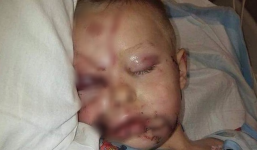 Bức ảnh mà các bậc phụ huynh nên lưu tâm chụp bé trai bị biến dạng khuôn mặt vì 2 con chó tấn công