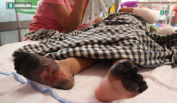 Sự thật về thông tin bé gái ở Lai Châu bị hoại tử chân tay do mắc bệnh Than hiếm gặp