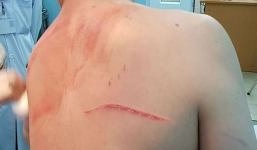 Bắt nhóm côn đồ truy sát bác sĩ Chiêm Quốc Thái