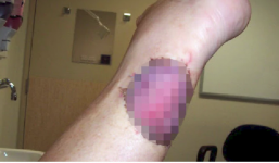 Không phải rắn độc hay cá sấu, vi khuẩn ăn thịt mới là thứ đang gieo rắc nỗi kinh hoàng cho người dân Úc