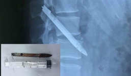 Lưỡi dao bị bỏ quên trong lưng chiến sỹ công an suốt 11 năm