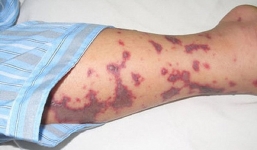 1 người mắc viêm não mô cầu khiến nhiều người phải cách ly: Bệnh này nguy hiểm thế nào?