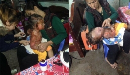 Ngã vào bỗng rượu đang sôi, bé gái 26 tháng tuổi bị bỏng nặng toàn thân