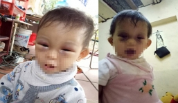 Bé gái 14 tháng tuổi bị tụ máu hai mắt sau khi từ cơ sở mầm non về