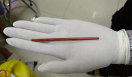 Nhậu say quên trời đất, tỉnh dậy thấy đũa 12 cm chui vào dương vật