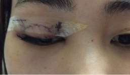 Bác sĩ BV Mắt trung ương kể chuyện vã mồ hôi phẫu thuật cho cô gái bị kim chui vào mí mắt