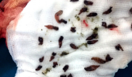 Gắp bỏ 1000 con sán trong ống mật của bệnh nhân