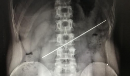 Nuốt thanh thép gần 20 cm vì cá cược 18 triệu đồng và cái giá đắt