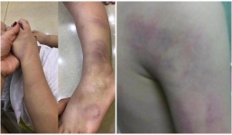 Nghi án cô giáo đánh học sinh lớp 1 bầm tím chân tay