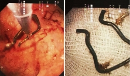 Khẩn cấp cứu bé trai 18 tháng tuổi nuốt cọng sắt nhọn rớt ra từ kẹp quần áo