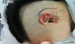 Hà Nội: Thanh niên ngồi nhậu bị bạn nhậu cắt đứt tai