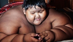 Hậu phẫu thuật thành công, cậu bé nặng nhất thế giới giảm gần nửa số cân, có cuộc sống bình thường