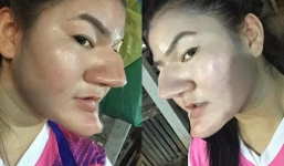 Sự thật đằng sau hình ảnh 'cô gái có gương mặt như phù thủy do thẩm mỹ hỏng' đang lan truyền trên MXH